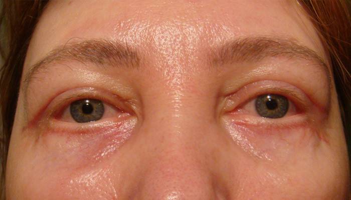 Hinchazón de los ojos de una mujer