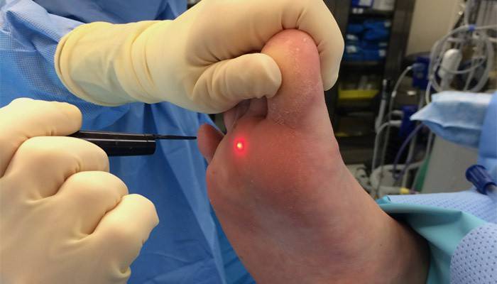 Tratamento a laser de milhos