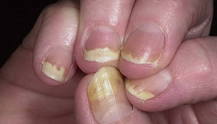 Sinais de psoríase nas unhas