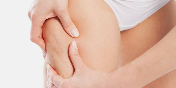 Celulitis en las piernas