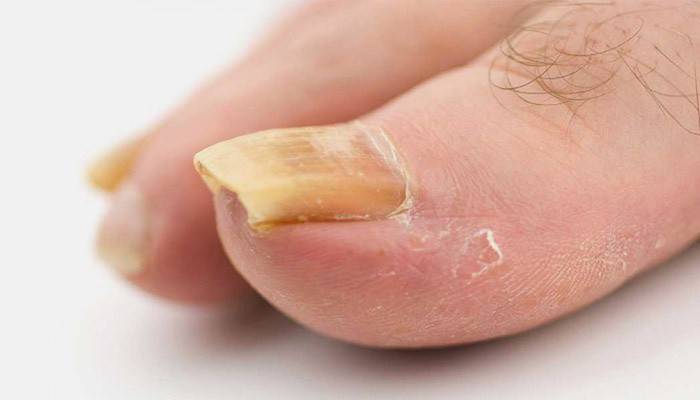 Sinais de psoríase das unhas dos pés