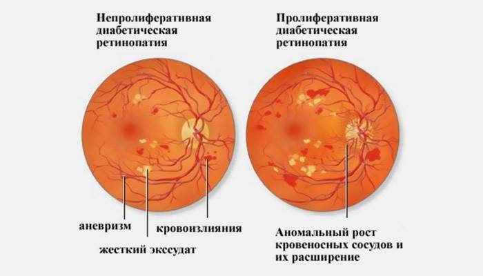 Etapy retinopatii w cukrzycy