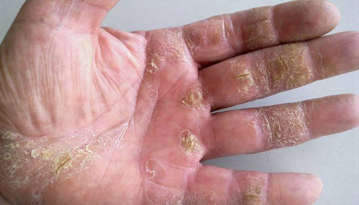 Psoriasis pustulosa de la palma