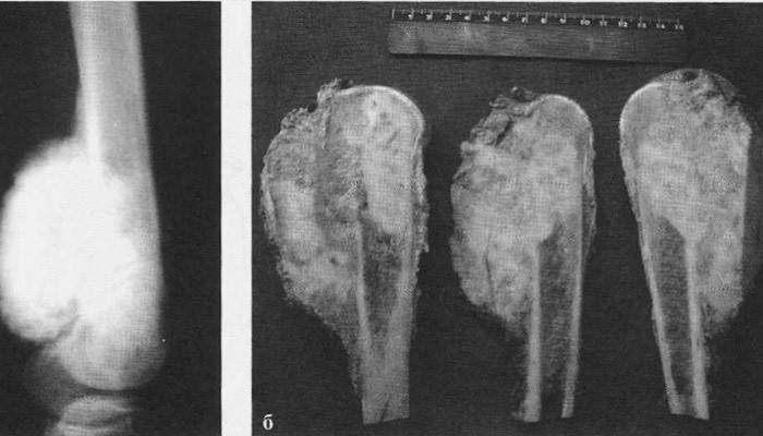 Tipos de sarcoma óseo