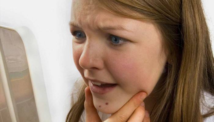 A menina descobriu a dermatite seborréica