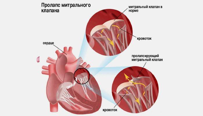 Prolapso de la válvula mitral y normal