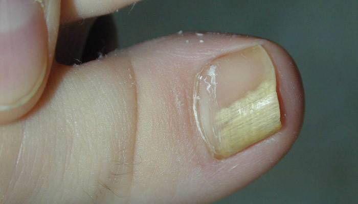 Daño por hongos en las uñas