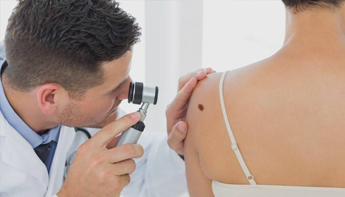 Um médico examina uma toupeira com um dermatoscópio