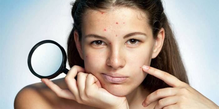 Acne em uma mulher
