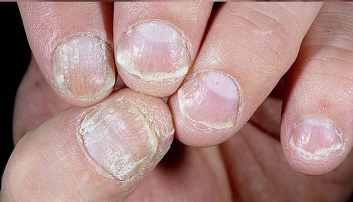 A manifestação da psoríase das unhas