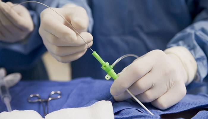 O curso da operação de stenting as embarcações do coração