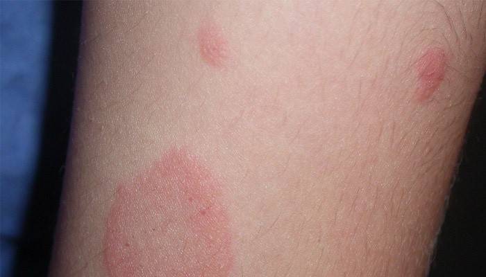 Psoriasis de la etapa inicial.