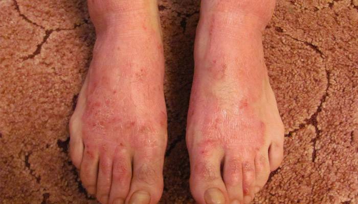 Psoriasis pustulosa de las plantas de los pies.
