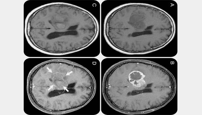 MRI mózgu
