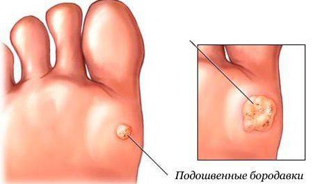 Verruga plantar