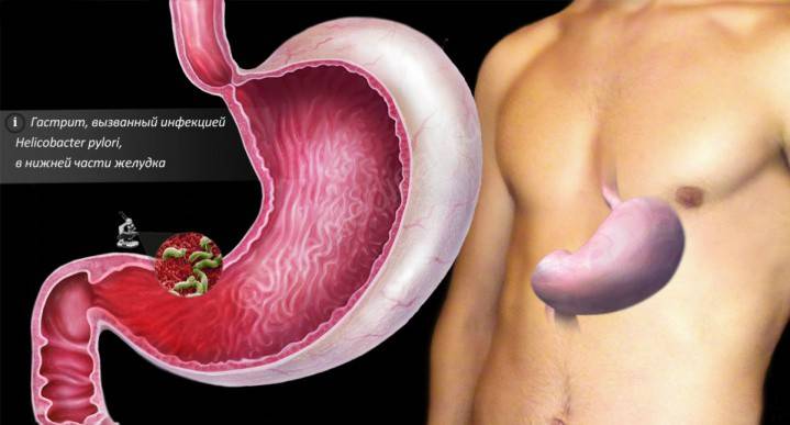 Gastritis erosiva antral
