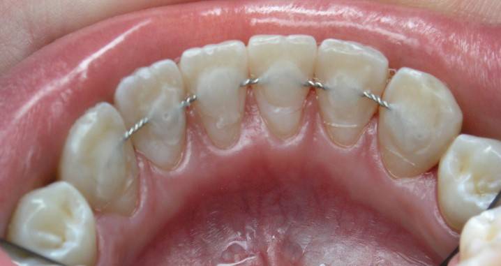 Dentes de tala