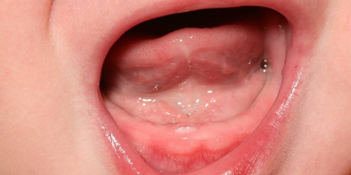 Hematomas y otras posibles enfermedades de las encías en bebés.