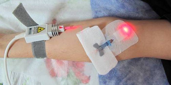 Laserowy proces oczyszczania krwi