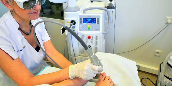 Tratamento a laser de fungos nas unhas
