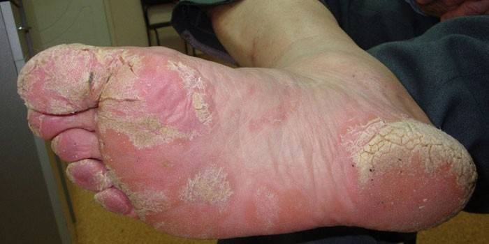 Etapa aguda de la psoriasis.