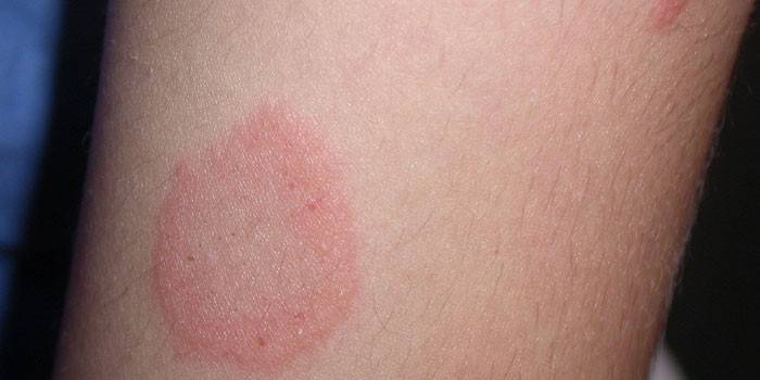 Pitiríase versicolor na pele humana
