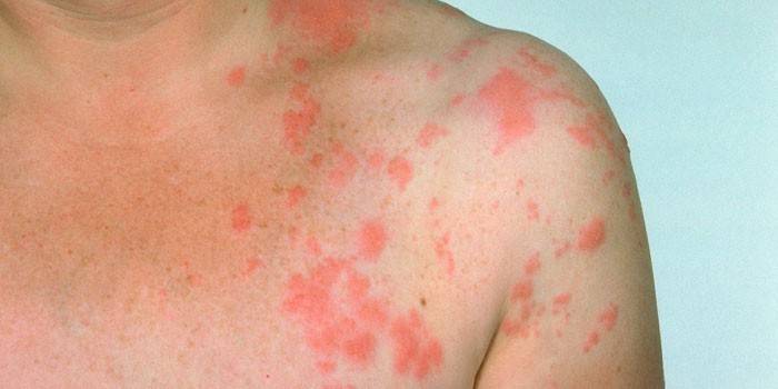 Herpes zoster na pele de um homem