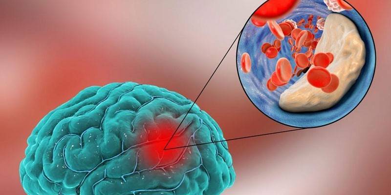 Acidente vascular cerebral aterotrombótico