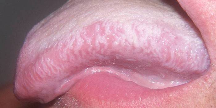 Leukoplakia v jazyku