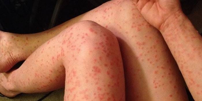 Psoriasis en el cuerpo.