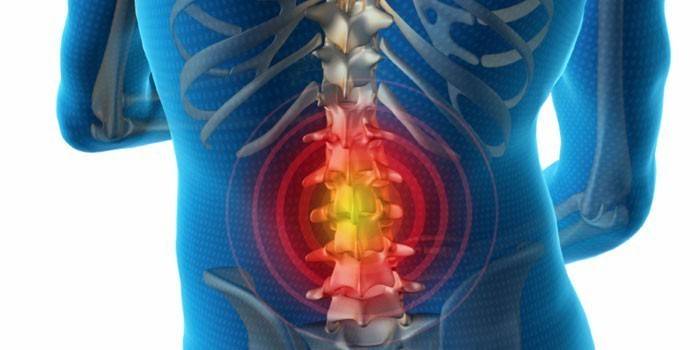 Esquema de la hernia intervertebral de la zona lumbar.