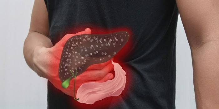 Inflamação do fígado e da vesícula biliar em um homem