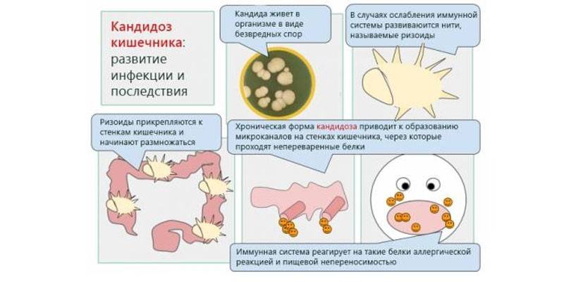Candidíase intestinal - desenvolvimento e consequências