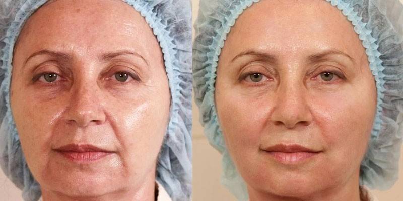 İplik kaldırma öncesi ve sonrası kadın fotoğrafı