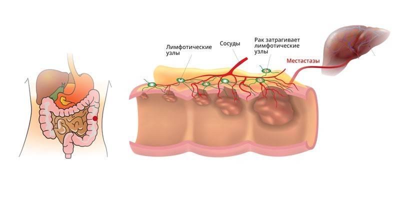 Câncer de intestino