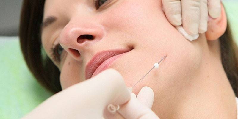 Procedimiento de refuerzo facial