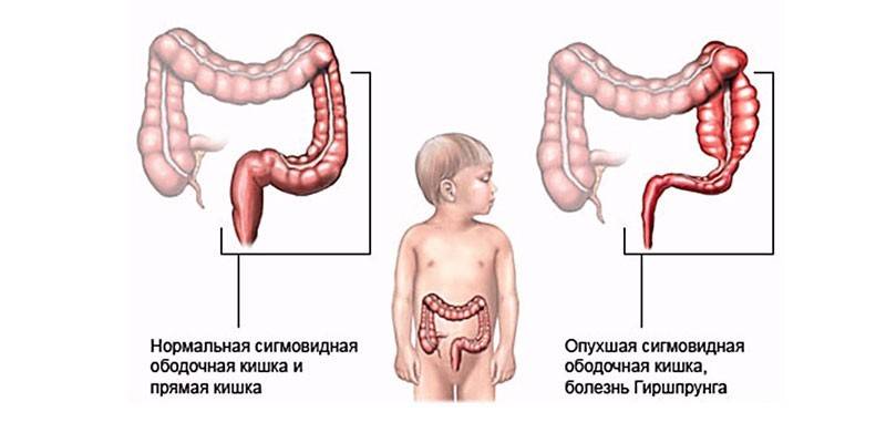 Colon sigmoide normal y enfermedad de Hirschsprung