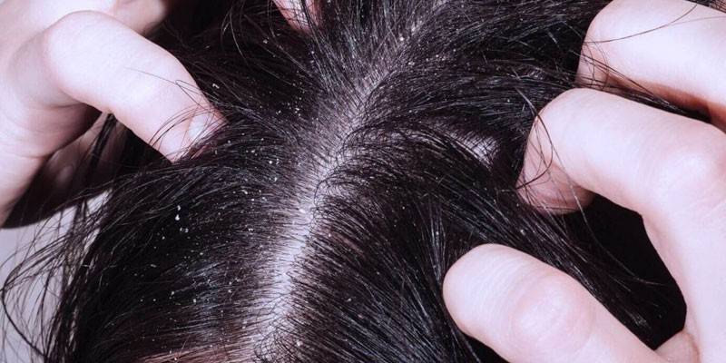 Caspa en el cabello.