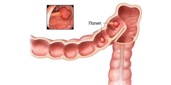 Pólipos intestinais