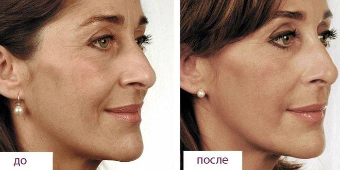 Foto de una mujer antes y después de la bioreparación