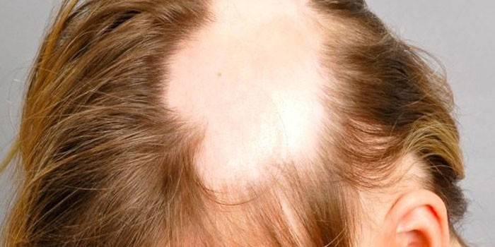 Alopecia