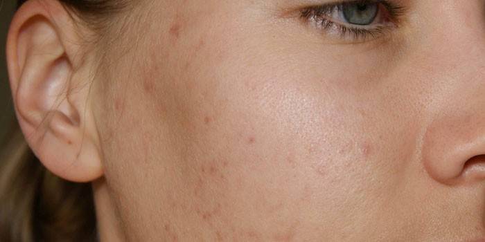 Enfermedades dermatológicas en la cara
