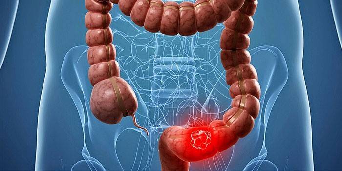 Oncologia do cólon sigmóide