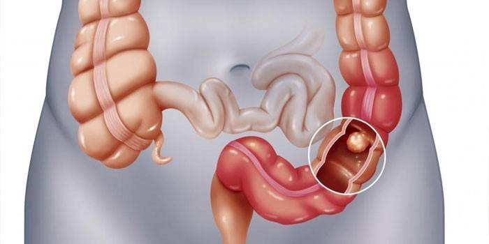 Pólipo rectal