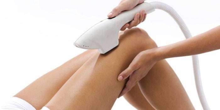 Fotodepilación de piernas