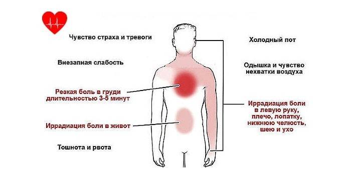 Sintomas de angina pectoris