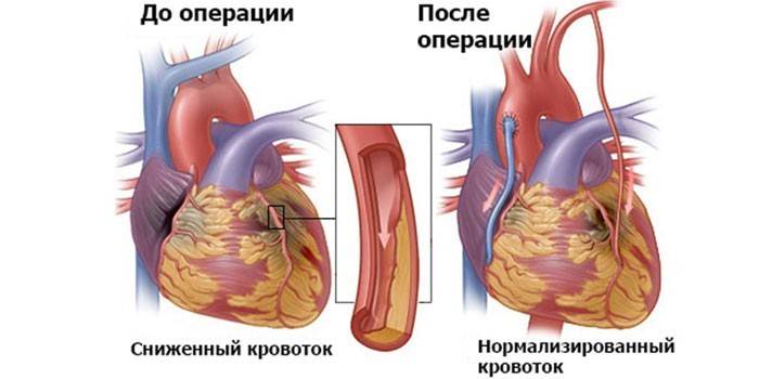 Pomostowanie tętnic wieńcowych