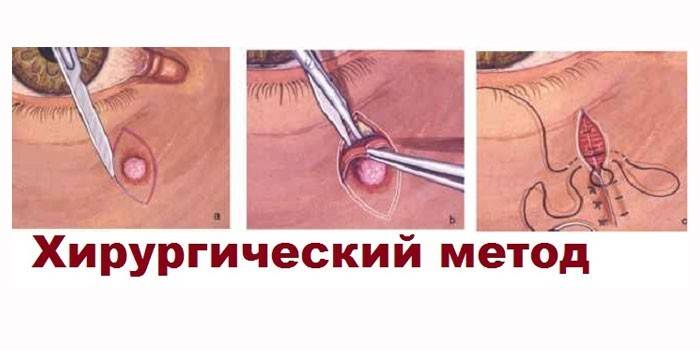 Metoda chirurgiczna