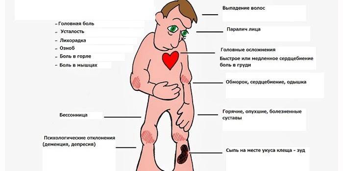 Objawy boreliozy