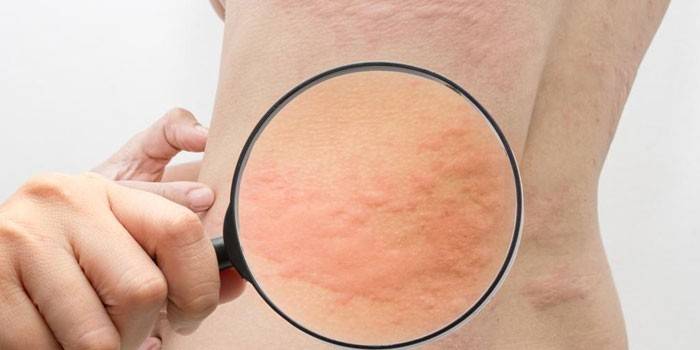 Alergická dermatitída